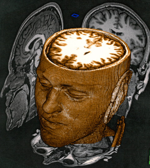 Autism & Mutation in the STRAD-Alpha Gene