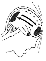 Autistic self Injury and Seizures