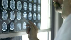 Autistic Children Have Heavier Brains?