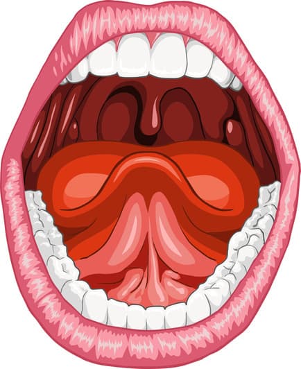 Ankyloglossia and Autism