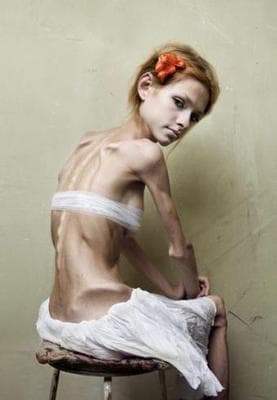 Anorexia linked to 'autistic' thinking